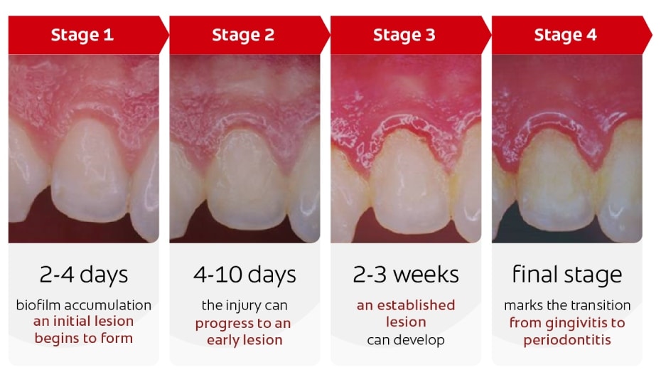 Evolución de la periodontitis