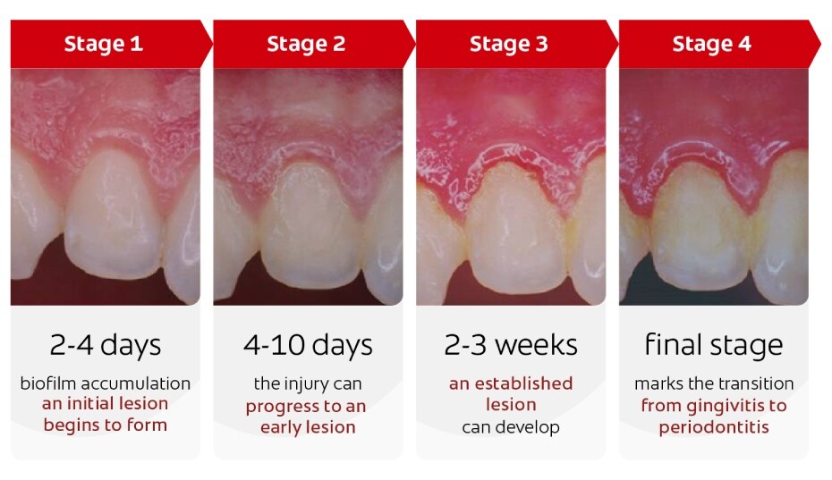 Evolución de la periodontitis