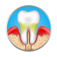 Sangrado gingival Sangrado gingival