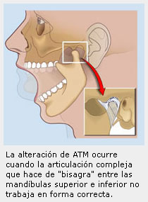 La alteración de la articulación temporomandibular