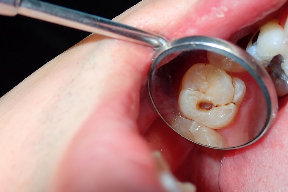 caries-dental-cavidad-encontrada-durante
